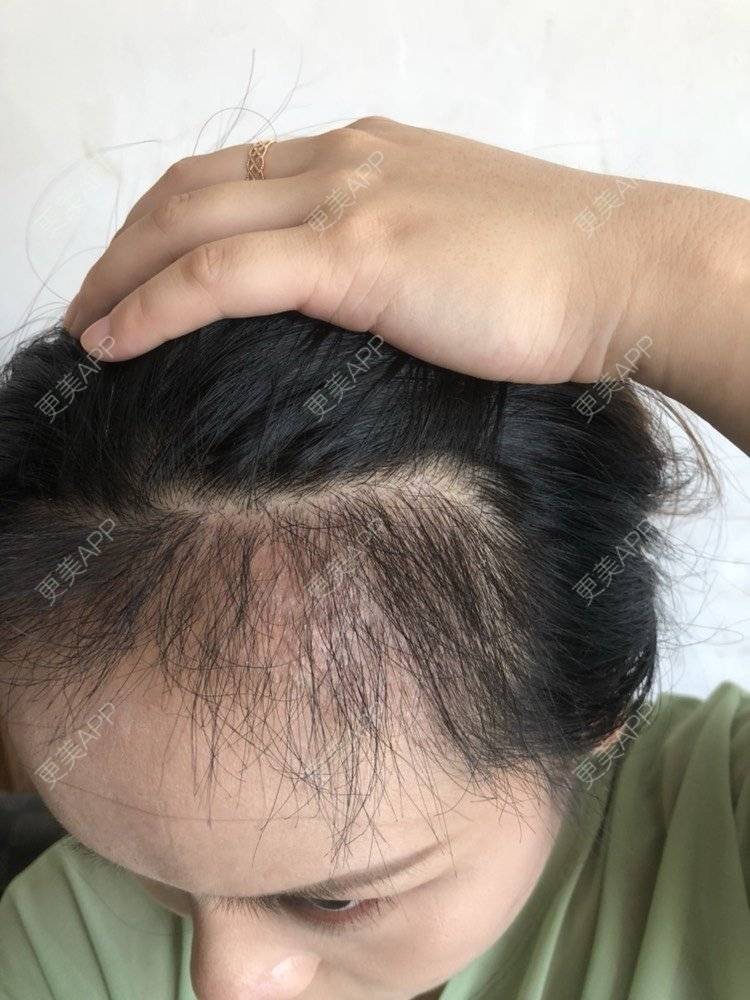 更美 - 奥多Ke。的植发际线经验 | 植发际线 | 南昌