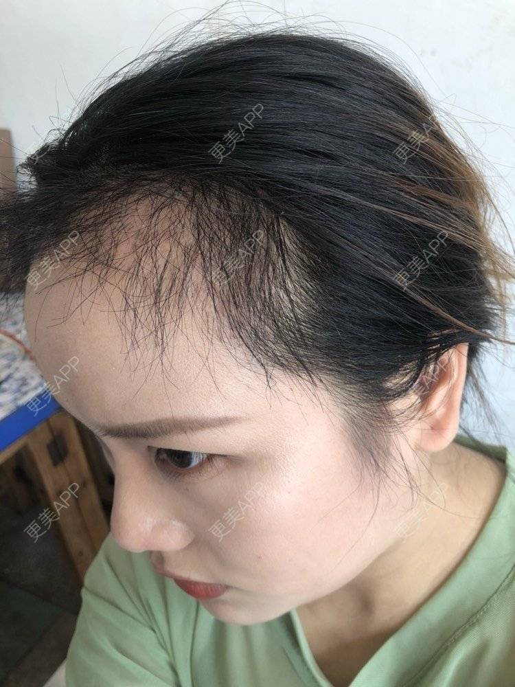 更美 - 奥多Ke。的植发际线经验 | 植发际线 | 南昌