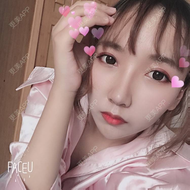 更美 - 林林兮兮的玻尿酸下巴经验 | 玻尿酸下巴 | 石家庄 | 玻尿酸