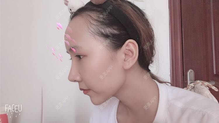 更美 - 林林兮兮的玻尿酸下巴经验 | 玻尿酸下巴 | 石家庄 | 玻尿酸