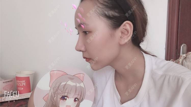 更美 - 林林兮兮的玻尿酸下巴经验 | 玻尿酸下巴 | 石家庄 | 玻尿酸