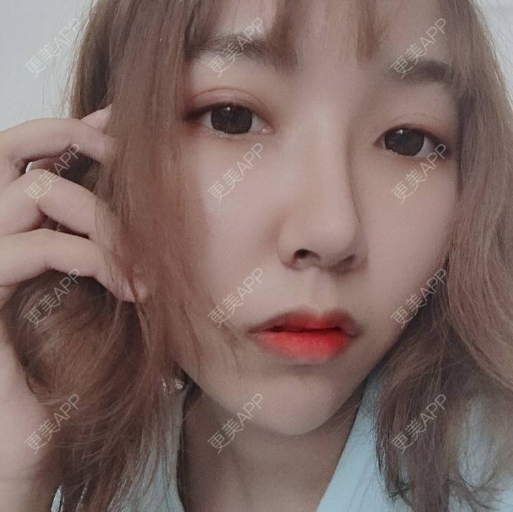 更美 - 林林兮兮的玻尿酸下巴经验 | 玻尿酸下巴 | 石家庄 | 玻尿酸