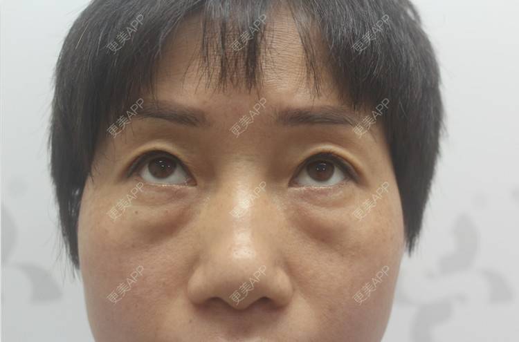 更美 - 踢毽子的小女孩2的外切去眼袋经验 | 外切去眼袋 | 广州