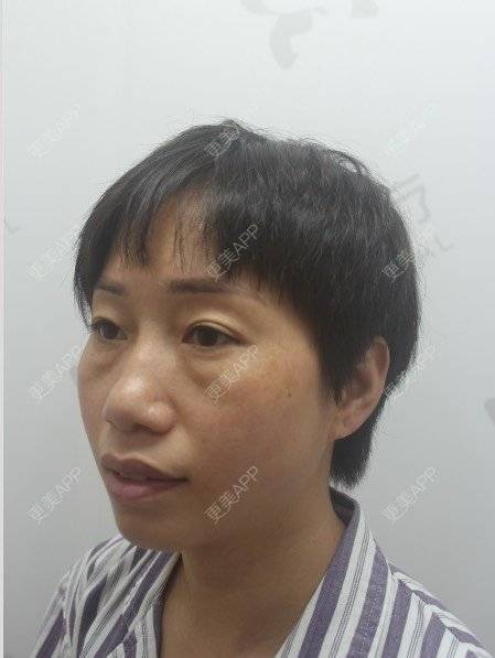 更美 - 踢毽子的小女孩2的外切去眼袋经验 | 外切去眼袋 | 广州