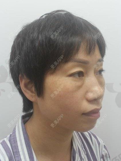 更美 - 踢毽子的小女孩2的外切去眼袋经验 | 外切去眼袋 | 广州