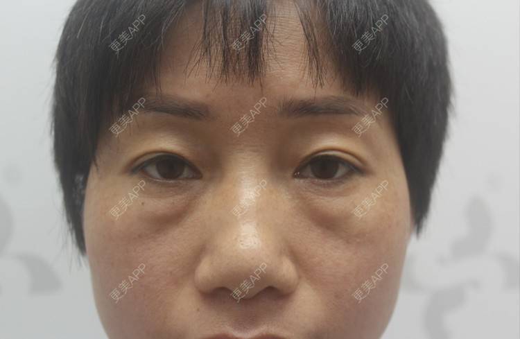 更美 - 踢毽子的小女孩2的外切去眼袋经验 | 外切去眼袋 | 广州