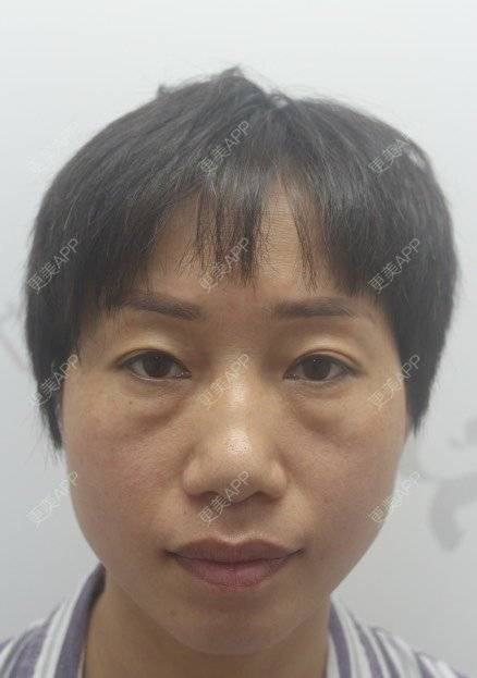 更美 - 踢毽子的小女孩2的外切去眼袋经验 | 外切去眼袋 | 广州