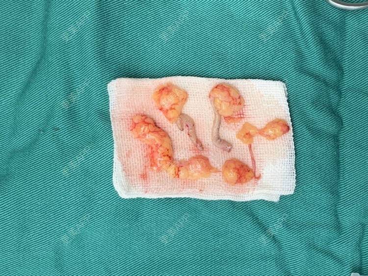 更美 - 踢毽子的小女孩2的外切去眼袋经验 | 外切去眼袋 | 广州