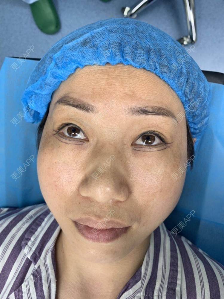 更美 - 踢毽子的小女孩2的外切去眼袋经验 | 外切去眼袋 | 广州