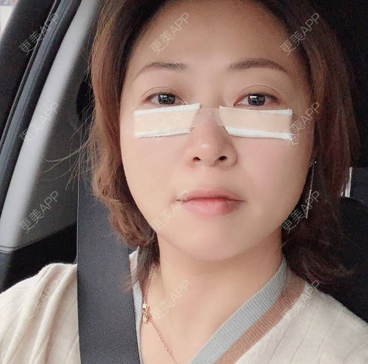更美 - 更美用户3OnH7nzrny的外切去眼袋经验 | 外切去眼袋 | 杭州