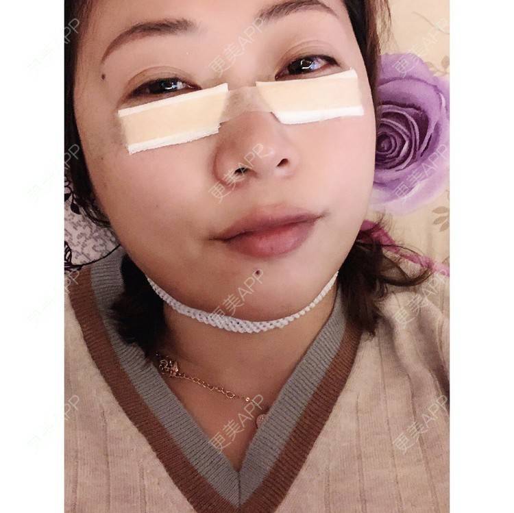 更美 - 更美用户3OnH7nzrny的外切去眼袋经验 | 外切去眼袋 | 杭州
