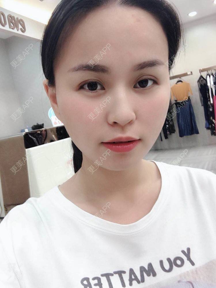 更美 - 更美用户aPZ5J5UfoG的全切双眼皮经验 | 深圳 | 全切双眼皮