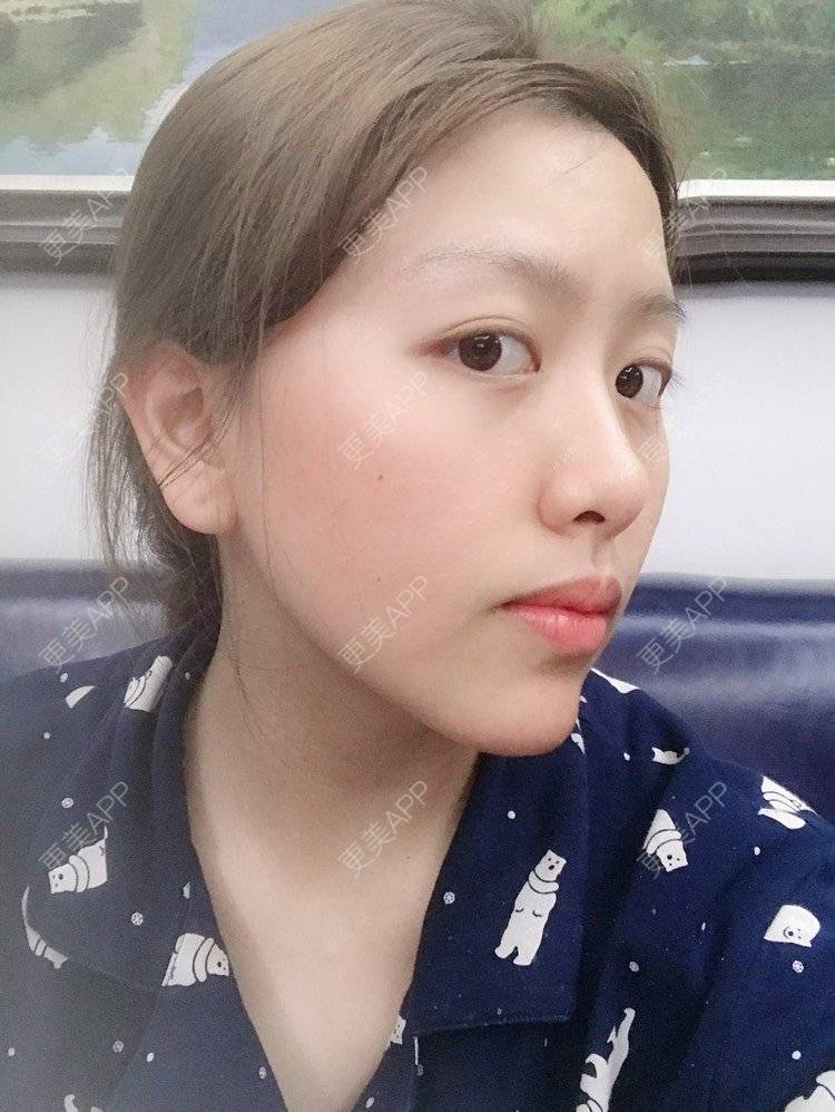 更美 - 夹心巧克力的自体脂肪丰臀经验 | 自体脂肪身体塑形 | 自体脂肪丰臀 | 吸脂塑臀 | 胶原蛋白丰臀 | 假体丰臀