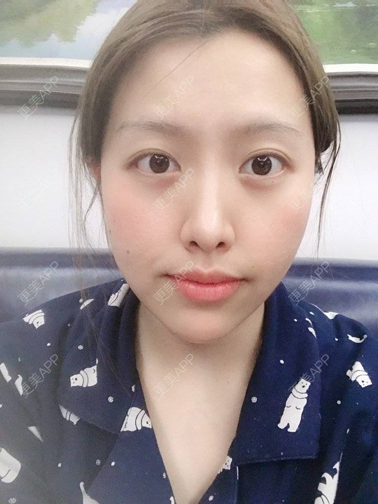 更美 - 夹心巧克力的自体脂肪丰臀经验 | 自体脂肪身体塑形 | 自体脂肪丰臀 | 吸脂塑臀 | 胶原蛋白丰臀 | 假体丰臀