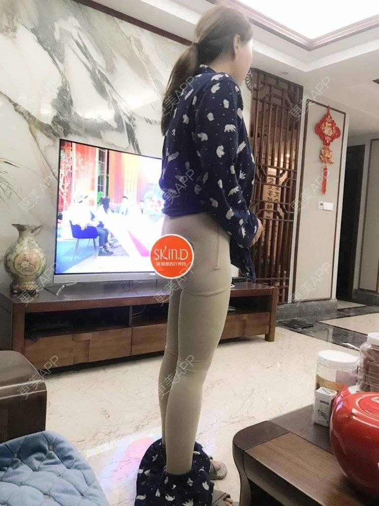 更美 - 夹心巧克力的自体脂肪丰臀经验 | 自体脂肪身体塑形 | 自体脂肪丰臀 | 吸脂塑臀 | 胶原蛋白丰臀 | 假体丰臀