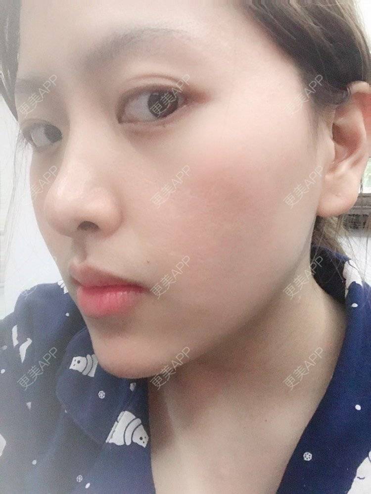 更美 - 夹心巧克力的自体脂肪丰臀经验 | 自体脂肪身体塑形 | 自体脂肪丰臀 | 吸脂塑臀 | 胶原蛋白丰臀 | 假体丰臀