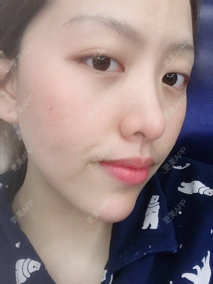 更美 - 夹心巧克力的自体脂肪丰臀经验 | 自体脂肪身体塑形 | 自体脂肪丰臀 | 吸脂塑臀 | 胶原蛋白丰臀 | 假体丰臀