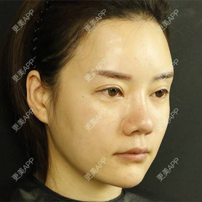 更美 - 灬紫色金城灬战队的玻尿酸卧蚕经验 | 玻尿酸卧蚕 | 深圳