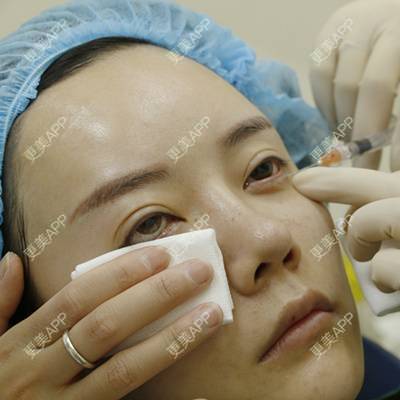 更美 - 灬紫色金城灬战队的玻尿酸卧蚕经验 | 玻尿酸卧蚕 | 深圳