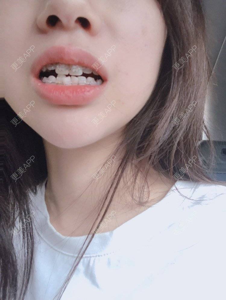 更美 - Jevakiki的牙齿矫正经验 | 牙齿矫正 | 上海