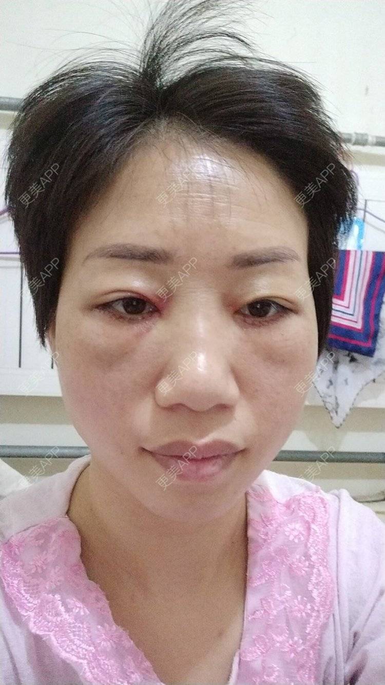 更美 - 踢毽子的小女孩2的外切去眼袋经验 | 视频日记 | 外切去眼袋 | 广州