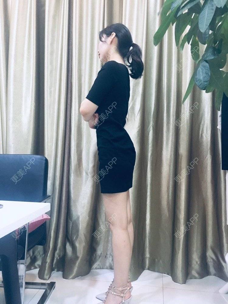更美 - 更美用户CQFZ0nNp0z的臀部经验 | 自体脂肪丰臀 | 胶原蛋白丰臀 | 射频溶脂塑臀 | 臀部 | 腰腹吸脂 | 吸脂瘦大腿 | 手臂吸脂 | 吸脂塑臀 | 假体丰臀