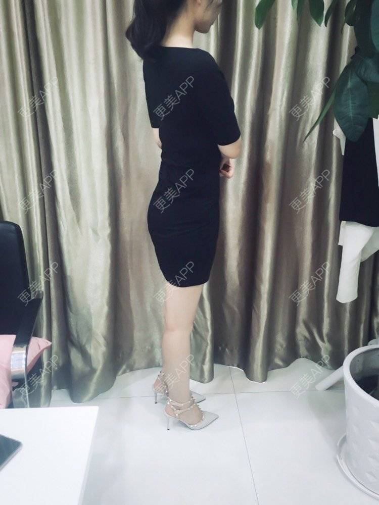 更美 - 更美用户CQFZ0nNp0z的臀部经验 | 自体脂肪丰臀 | 胶原蛋白丰臀 | 射频溶脂塑臀 | 臀部 | 腰腹吸脂 | 吸脂瘦大腿 | 手臂吸脂 | 吸脂塑臀 | 假体丰臀