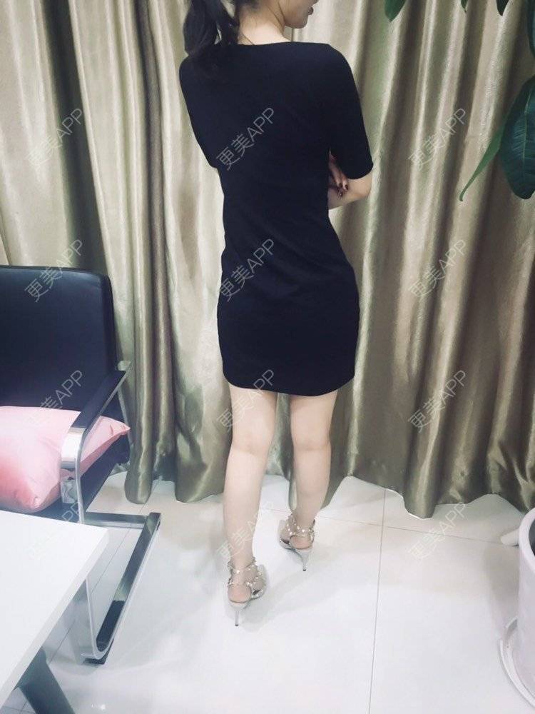 更美 - 更美用户CQFZ0nNp0z的臀部经验 | 自体脂肪丰臀 | 胶原蛋白丰臀 | 射频溶脂塑臀 | 臀部 | 腰腹吸脂 | 吸脂瘦大腿 | 手臂吸脂 | 吸脂塑臀 | 假体丰臀