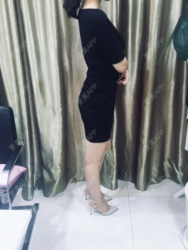 更美 - 更美用户CQFZ0nNp0z的臀部经验 | 自体脂肪丰臀 | 胶原蛋白丰臀 | 射频溶脂塑臀 | 臀部 | 腰腹吸脂 | 吸脂瘦大腿 | 手臂吸脂 | 吸脂塑臀 | 假体丰臀