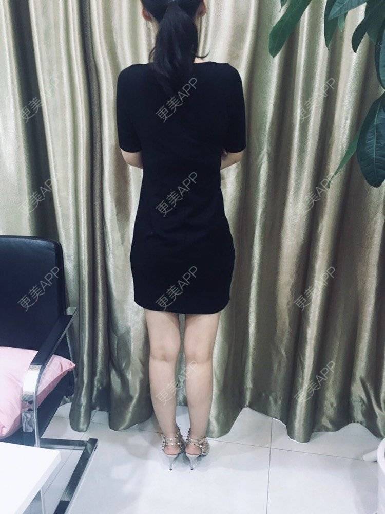更美 - 更美用户CQFZ0nNp0z的臀部经验 | 自体脂肪丰臀 | 胶原蛋白丰臀 | 射频溶脂塑臀 | 臀部 | 腰腹吸脂 | 吸脂瘦大腿 | 手臂吸脂 | 吸脂塑臀 | 假体丰臀