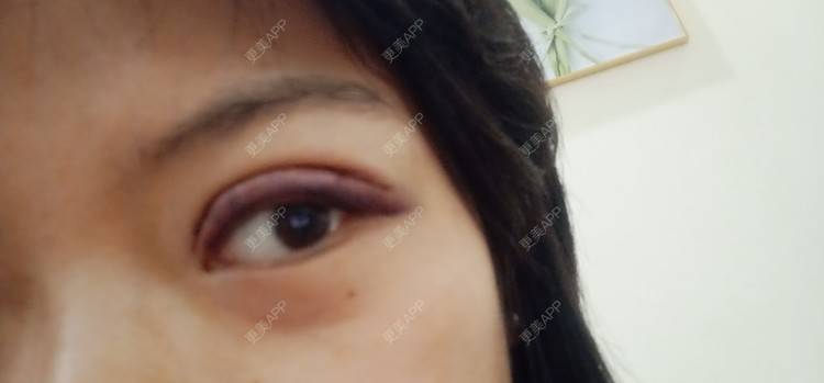更美 - 糊糊的全切双眼皮经验 | 全切双眼皮 | 潍坊