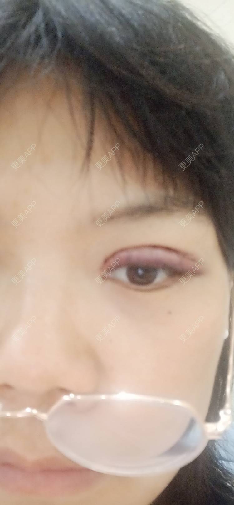 更美 - 糊糊的全切双眼皮经验 | 全切双眼皮 | 潍坊
