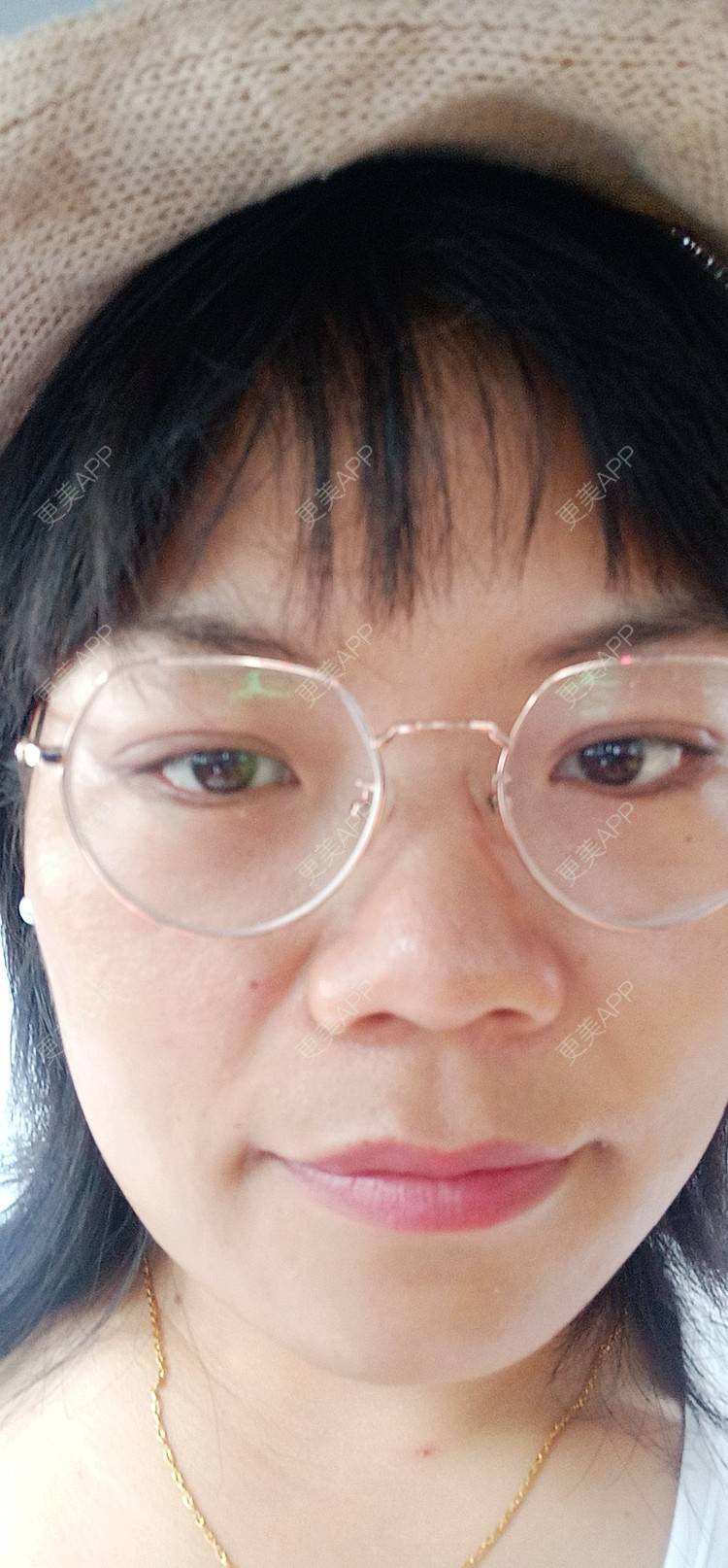 更美 - 糊糊的全切双眼皮经验 | 全切双眼皮 | 潍坊