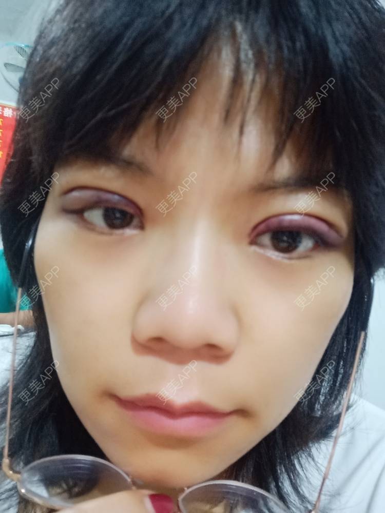 更美 - 糊糊的全切双眼皮经验 | 全切双眼皮 | 潍坊