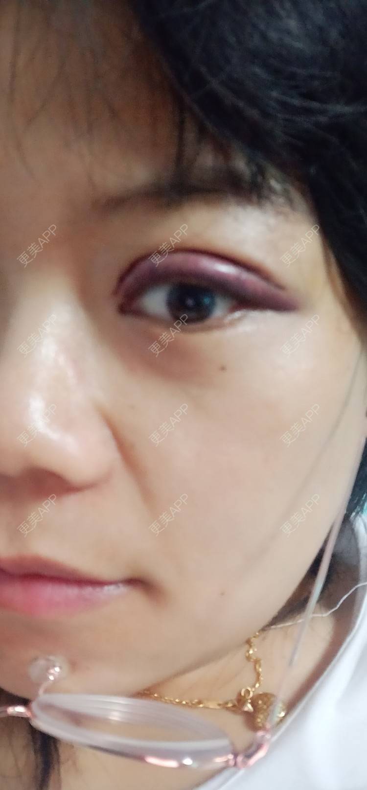 更美 - 糊糊的全切双眼皮经验 | 全切双眼皮 | 潍坊