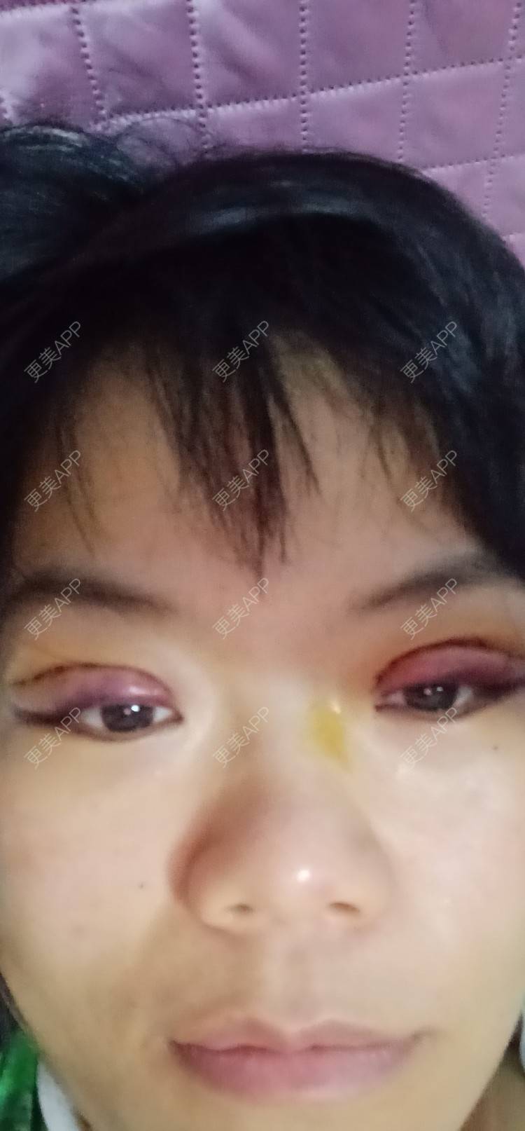 更美 - 糊糊的全切双眼皮经验 | 全切双眼皮 | 潍坊