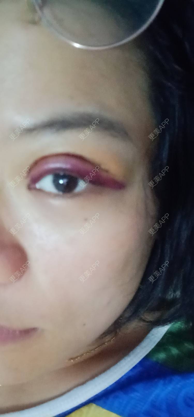 更美 - 糊糊的全切双眼皮经验 | 全切双眼皮 | 潍坊