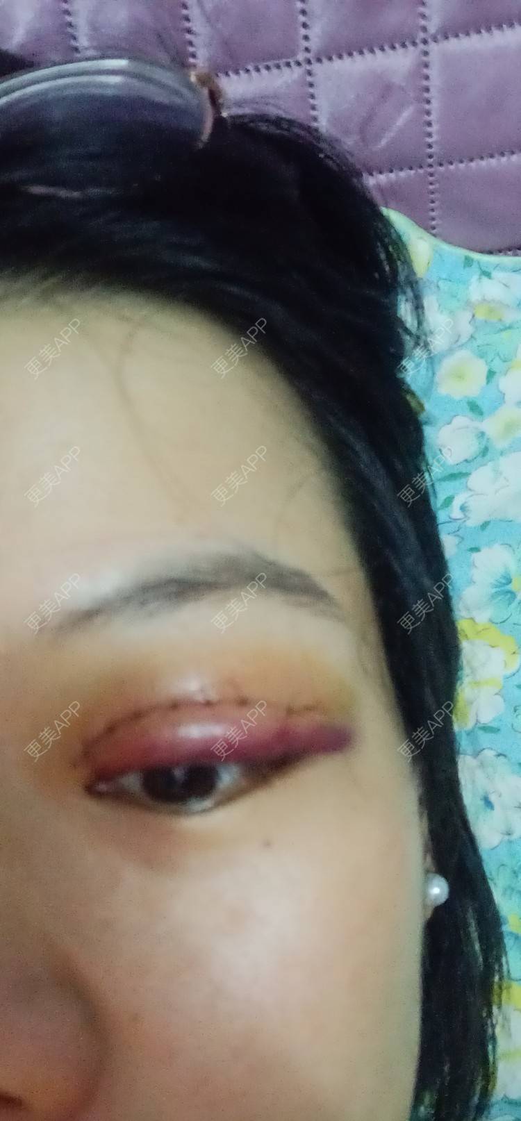 更美 - 糊糊的全切双眼皮经验 | 全切双眼皮 | 潍坊