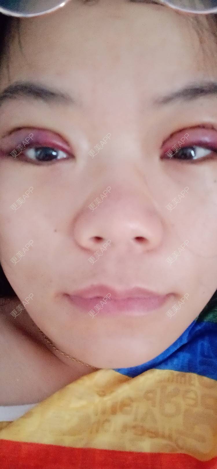 更美 - 糊糊的全切双眼皮经验 | 全切双眼皮 | 潍坊