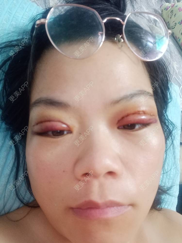 更美 - 糊糊的全切双眼皮经验 | 全切双眼皮 | 潍坊