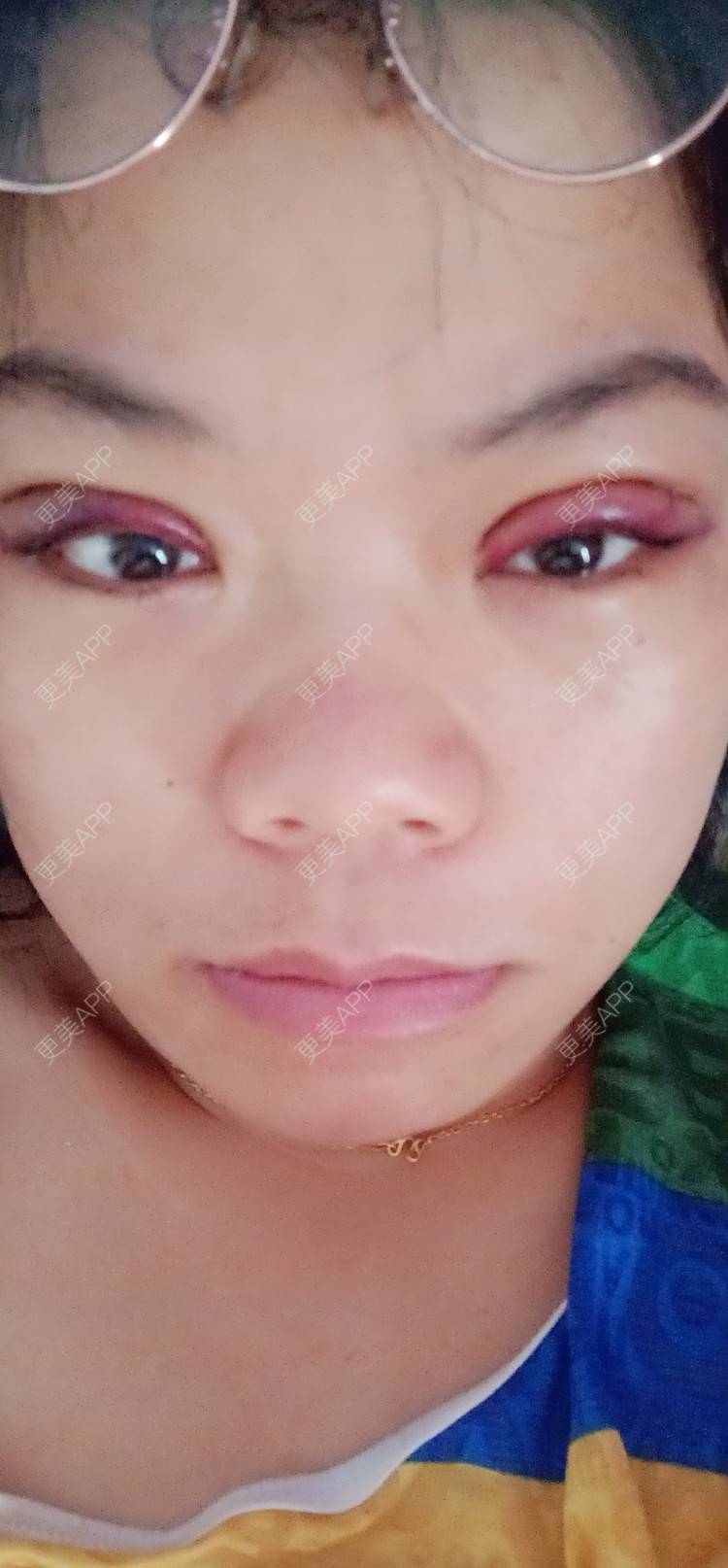 更美 - 糊糊的全切双眼皮经验 | 全切双眼皮 | 潍坊