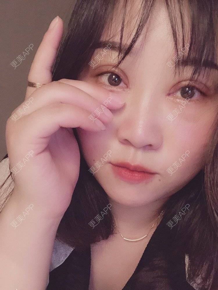 更美 - 🌸 ꧁꫞꯭辛꯭德꯭瑞꯭拉꯭꫞꧂的全切双眼皮经验 | 全切双眼皮 | 开内眼角 | 双眼皮修复