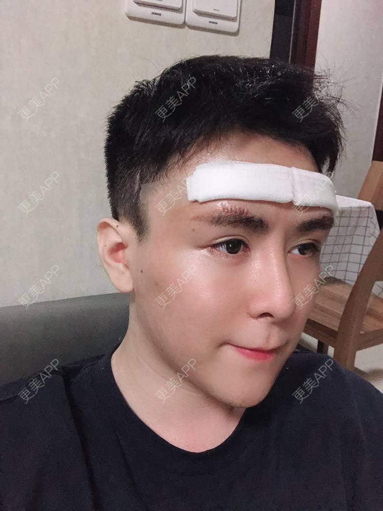更美 - 陈温柔~的膨体垫眉弓经验 | 膨体垫眉弓 | 膨体垫下巴 | 膨体丰额头 | 重庆 | 视频日记