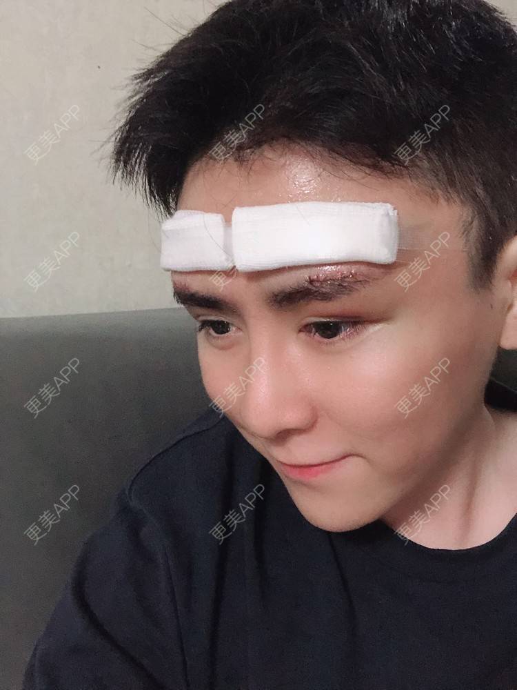 更美 - 陈温柔~的膨体垫眉弓经验 | 膨体垫眉弓 | 膨体垫下巴 | 膨体丰额头 | 重庆 | 视频日记