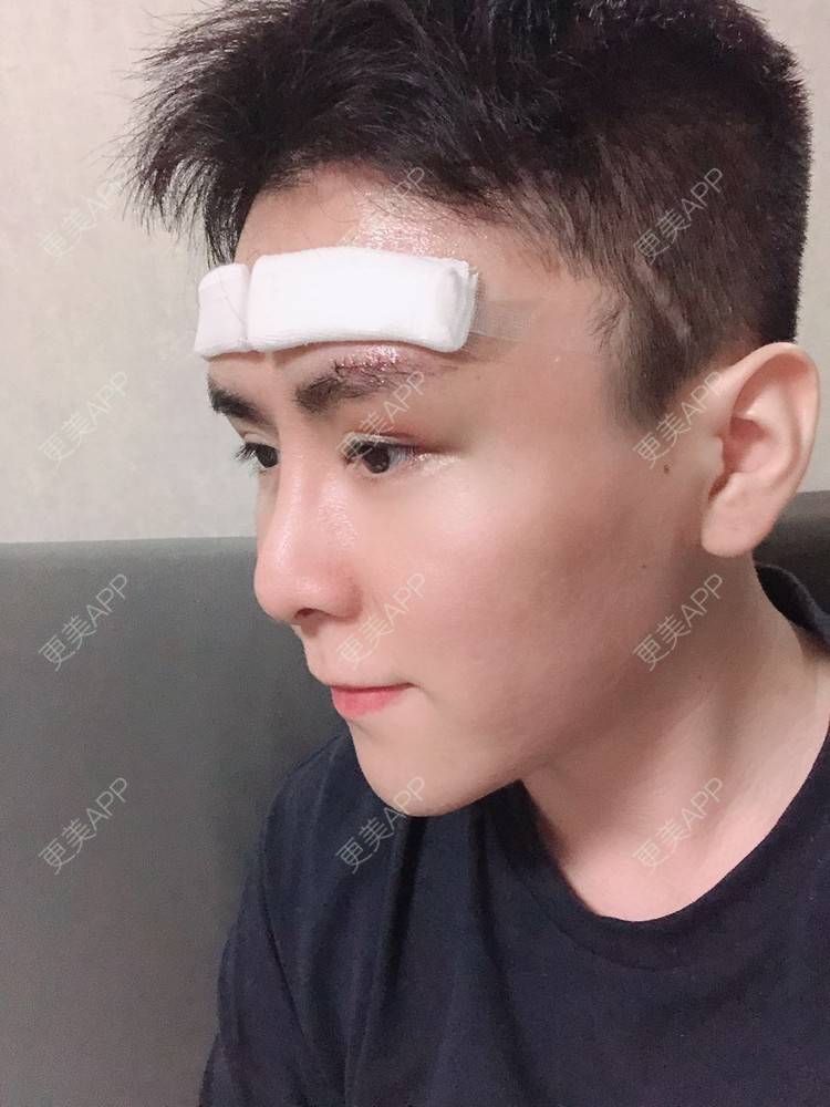 更美 - 陈温柔~的膨体垫眉弓经验 | 膨体垫眉弓 | 膨体垫下巴 | 膨体丰额头 | 重庆 | 视频日记