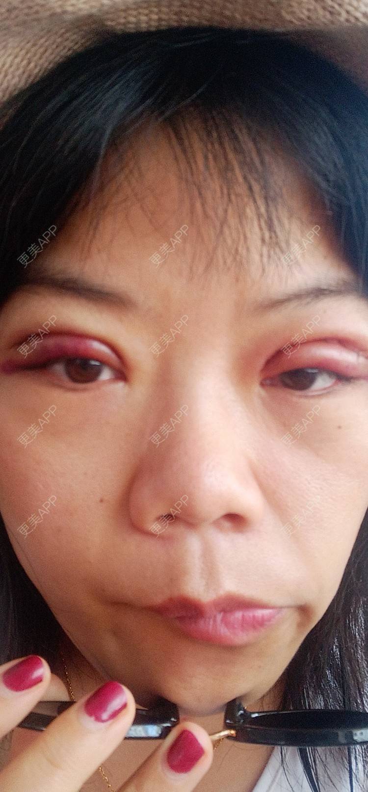 更美 - 糊糊的全切双眼皮经验 | 全切双眼皮 | 潍坊