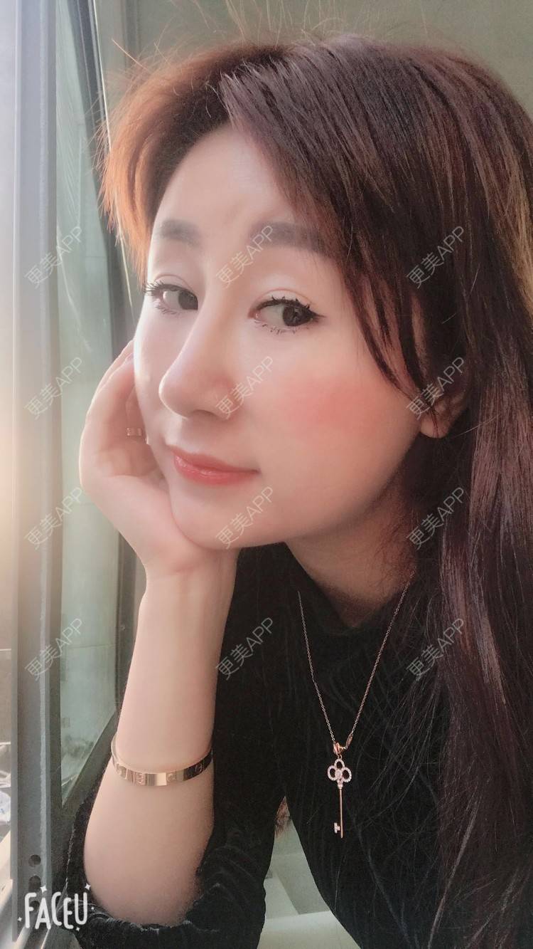 更美 - 更美用户A29SpkoKUU的手术缩鼻头经验 | 手术缩鼻头 | 上海