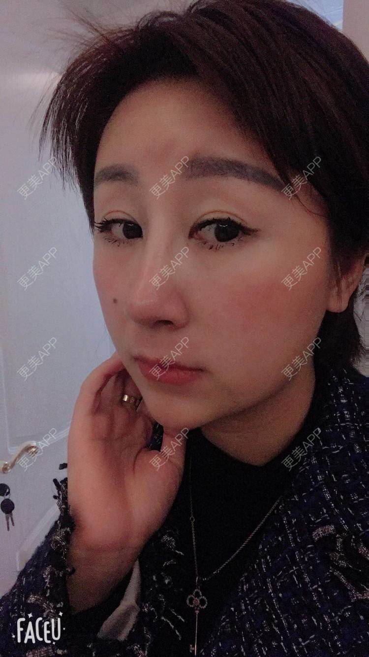 更美 - 更美用户A29SpkoKUU的手术缩鼻头经验 | 手术缩鼻头 | 上海