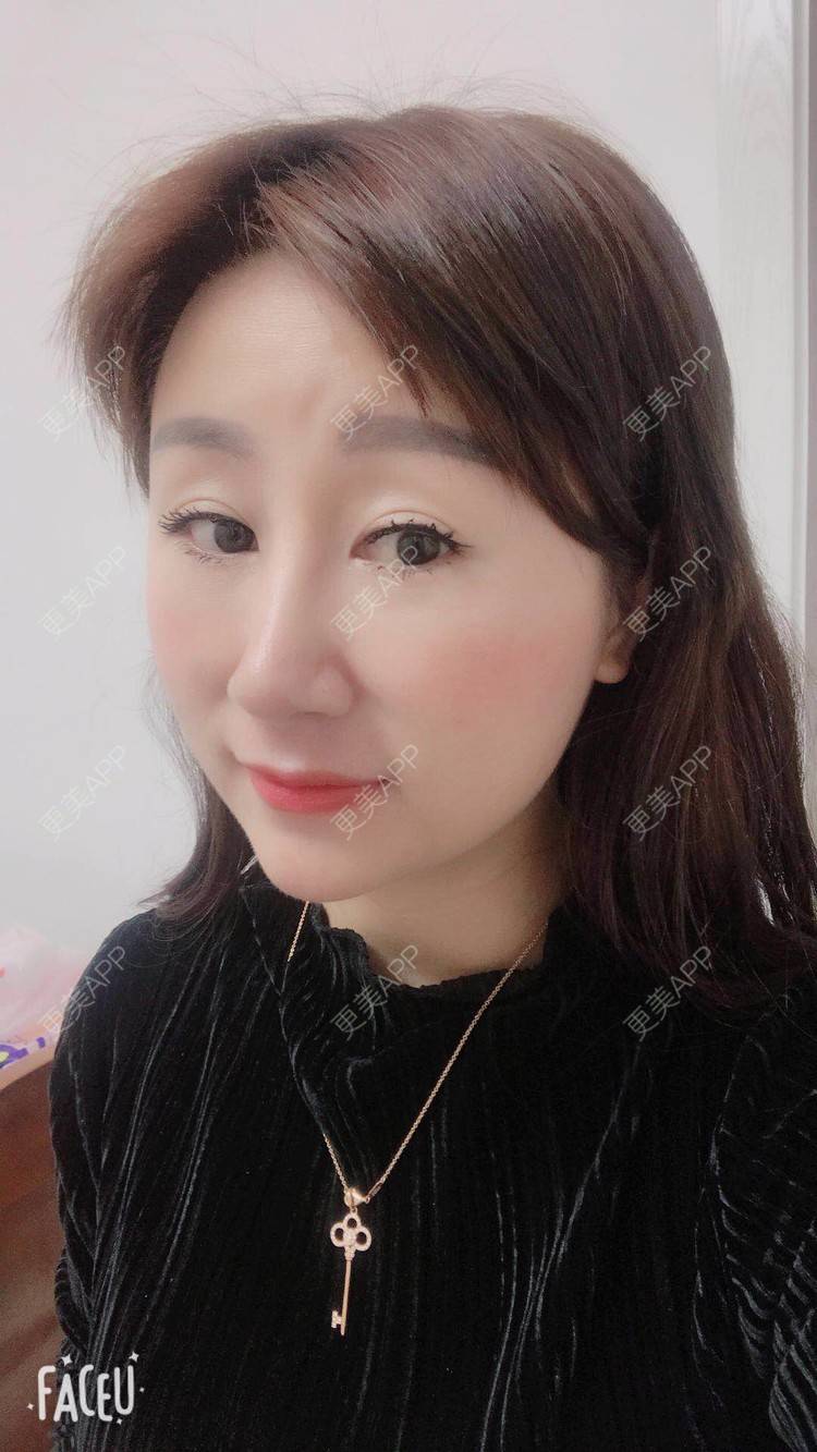 更美 - 更美用户A29SpkoKUU的手术缩鼻头经验 | 手术缩鼻头 | 上海