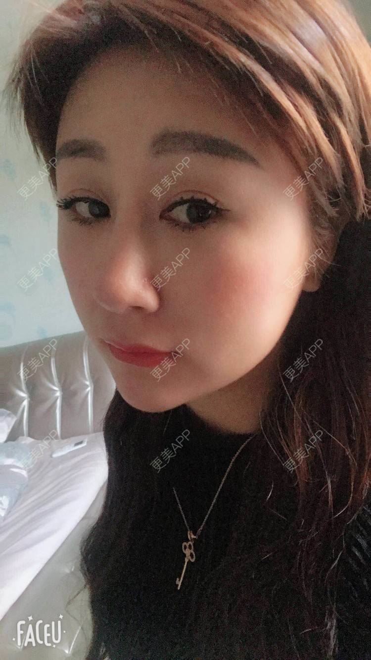 更美 - 更美用户A29SpkoKUU的手术缩鼻头经验 | 手术缩鼻头 | 上海